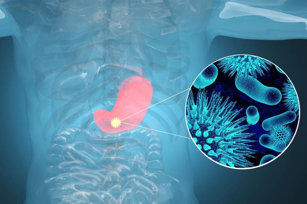 肿瘤标记物CA72-4：“胃”，你还好吗？